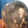 What is Alopecia areata?