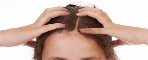 What is Female Pattern Baldness?