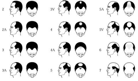 Male Pattern Baldness Norwood Scale